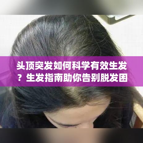 頭頂突發(fā)如何科學有效生發(fā)？生發(fā)指南助你告別脫發(fā)困擾！