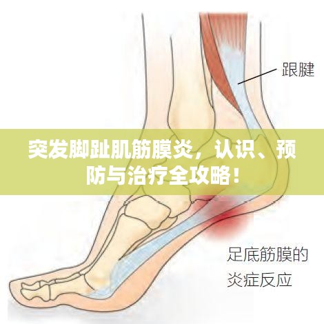 突發(fā)腳趾肌筋膜炎，認(rèn)識(shí)、預(yù)防與治療全攻略！