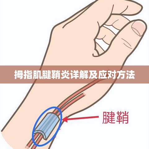 拇指肌腱鞘炎詳解及應(yīng)對(duì)方法